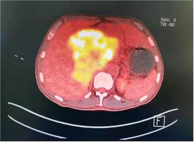 Case Report: A 65-year-old man with paraganglioma accompanied by elevated interleukin-6 levels and KIF1B single gene mutation